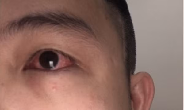 Đỏ mắt - di chứng Covid cần cẩn trọng