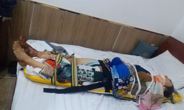Rơi thang máy khách sạn ở TP.HCM, một cô gái bị chấn thương cột sống