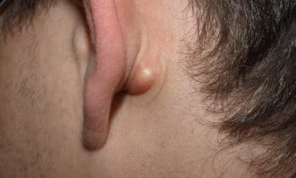 Nổi hạch sau tai: Trường hợp nào là dấu hiệu ung thư