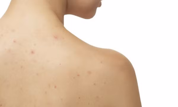 Lý do cứ nắng nóng lại dễ nổi mụn lưng