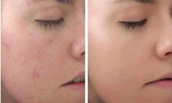 Những điều cần biết về peel da làm trắng