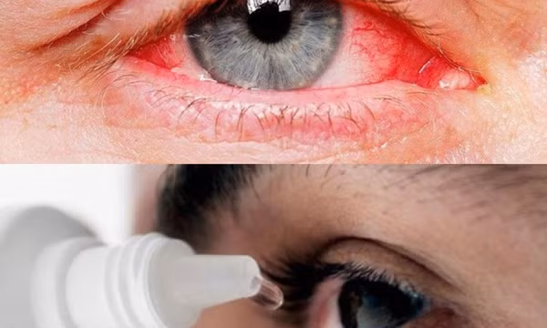Đau mắt đỏ có thể biến chứng nguy hiểm, thậm chí mất thị lực
