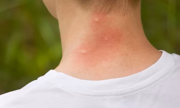 Phòng ngừa và xử trí đúng cách côn trùng đốt khi du xuân tránh biến chứng nguy hiểm