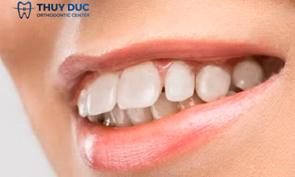 Niềng răng hô nhẹ mất bao lâu? Xem giải đáp chi tiết