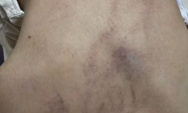 Bộ Y tế vào cuộc, trưng cầu giám định bé 4 tuổi bị cô giáo bạo hành