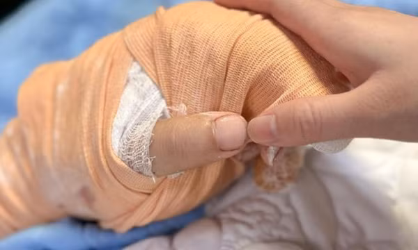 Nối lại thành công bàn tay bị chém lìa của nam TikToker có tiếng ở Thái Nguyên