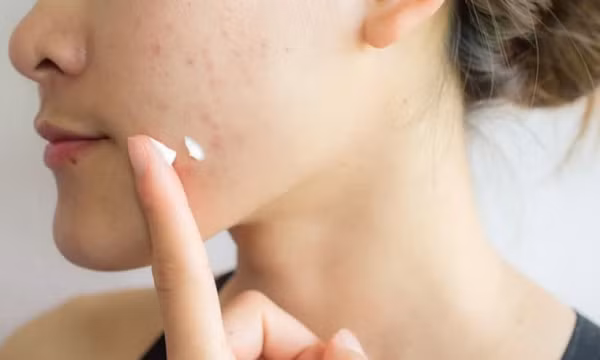 Da mụn nên trang điểm thế nào vừa che khuyết điểm vừa không gây bí da?