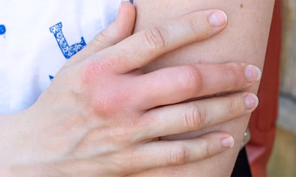 5 bất thường ở tay chân cảnh báo tắc nghẽn mạch máu