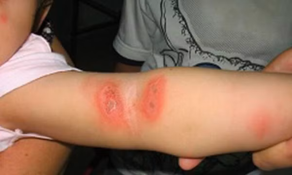Mùa hè cảnh giác với bệnh da do côn trùng
