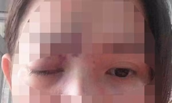 Thiếu nữ mù mắt, nhập viện cấp cứu vì tiêm filler thẩm mỹ ở tiệm cắt tóc, gội đầu