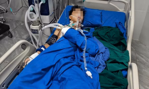 Tự chế tạo pháo, học sinh lớp 10 bị nổ nát bàn tay