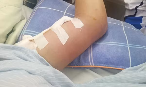 Nguy cơ nhiễm dịch bệnh sau bão lũ: Cảnh giác với bệnh whitmore