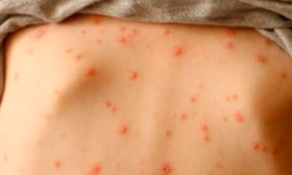 Bệnh thuỷ đậu ở người lớn: Bác sĩ lưu ý những biến chứng viêm phổi, viêm não
