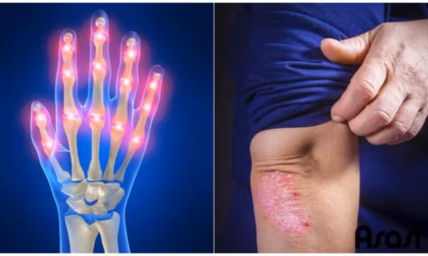 Viêm khớp vảy nến có chữa dứt điểm được không?