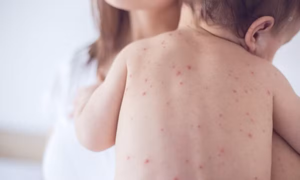 Sốt xuất huyết trái mùa