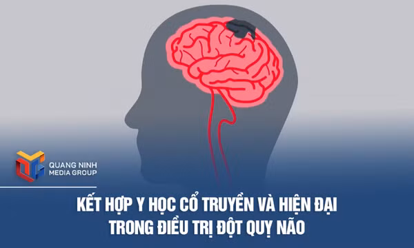 Kết hợp y học cổ truyền và hiện đại trong điều trị đột quỵ não