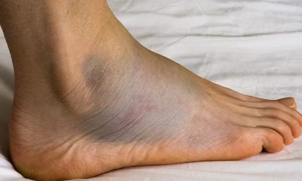 Những dấu hiệu cảnh báo suy tim dễ bị bỏ qua