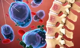 Phương pháp điều trị mới mang lại hy vọng cho bệnh nhân mắc bệnh xơ tủy