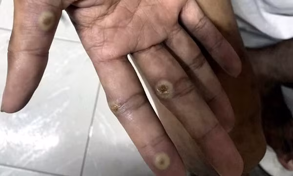 Đồng Nai xuất hiện ca đậu mùa khỉ chưa rõ nguồn lây, ngành y tế khẩn trương truy vết