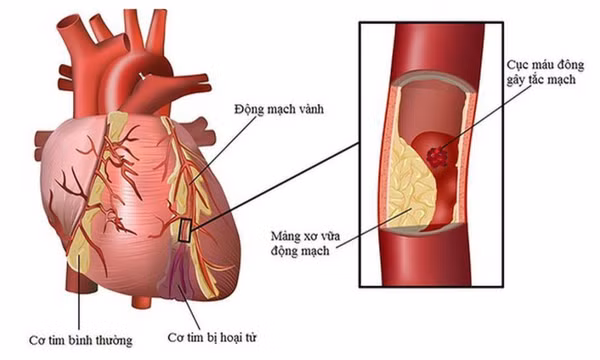 5 biện pháp giảm nguy cơ biến cố tim mạch khi thời tiết lạnh