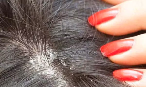 Nấm da đầu có gây rụng tóc không?