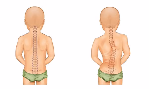 Làm gì khi trẻ gù lưng, cong vẹo cột sống do dùng điện thoại quá nhiều?