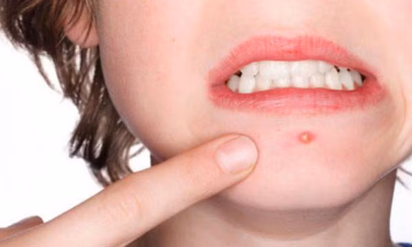 Không chủ quan với nhọt vùng cổ, mặt