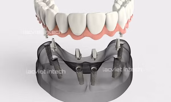 Trồng răng Implant All on 6: Xóa bỏ nỗi lo mất răng toàn hàm