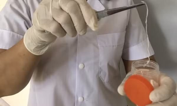 Con giun rồng ký sinh trong đùi người đàn ông