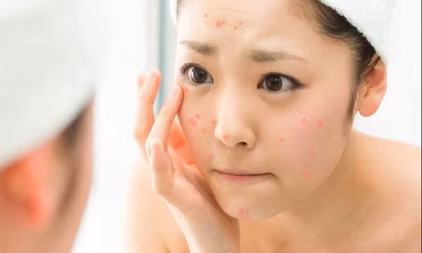Các dấu hiệu dị ứng mỹ phẩm