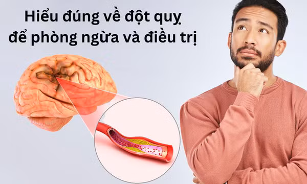 Những lầm tưởng về đột quỵ khiến bạn bỏ qua cơ hội vàng