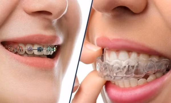 Niềng răng - Phương pháp chỉnh nha chuẩn quốc tế tại Nha khoa Shark