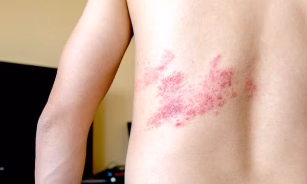 Số ca mắc thủy đậu tăng nhanh, virus thủy đậu tái phát có thể gây zona thần kinh