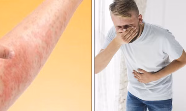 Cách nhận biết giữa dị ứng thực phẩm và ngộ độc thực phẩm