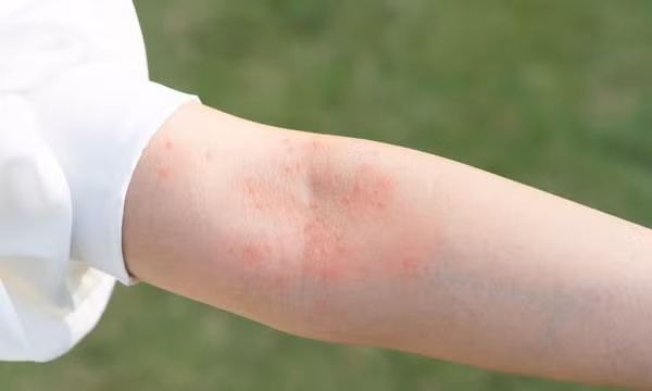 Những việc cần làm để 'cứu nguy' khi da bị dị ứng mỹ phẩm