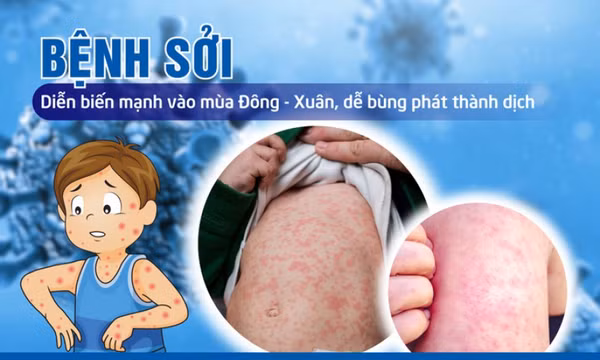 Không chủ quan với bệnh sởi có nguy cơ bùng phát