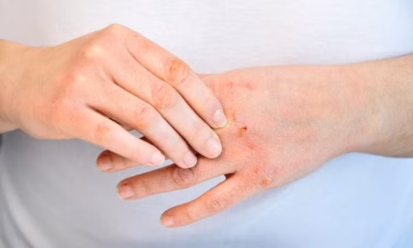 Khắc phục da tay khô trong mùa đông