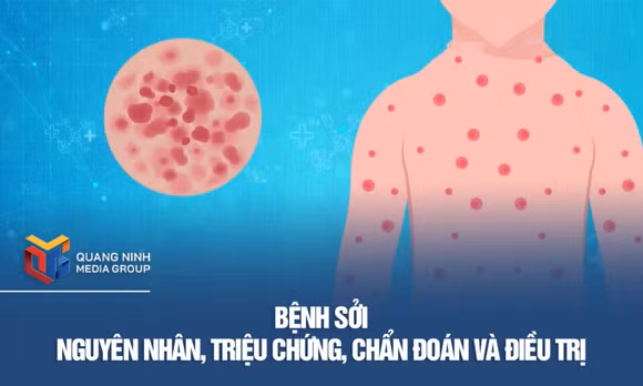 Nguyên nhân, triệu chứng, chẩn đoán và điều trị bệnh sởi