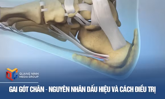 Gai gót chân - Nguyên nhân dấu hiệu và cách điều trị