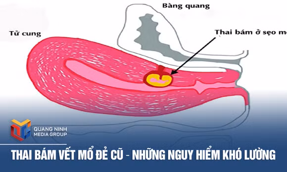 Thai bám vết mổ đẻ cũ – Những nguy hiểm khó lường
