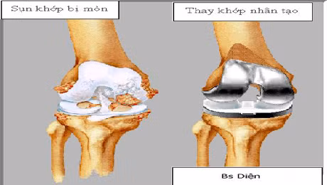 Điều trị thoái hóa khớp gối